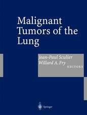 Malignant Tumors of the Lung: Evidence-based Management