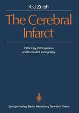 The Cerebral Infarct: Pathology, Pathogenesis, and Computed Tomography