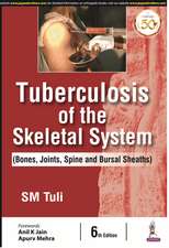 Tuberculosis of the Skeletal System